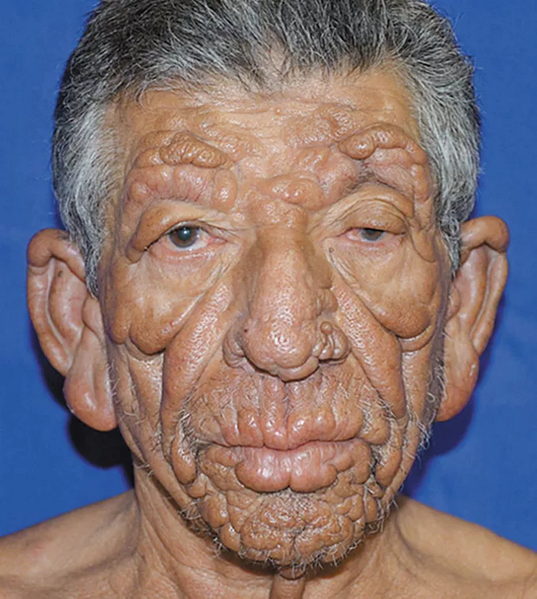 Vaizdas:Raupsai liuto veidas gumbai simptomai.webp